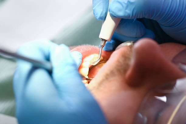 Best Emergency Tooth Extraction in Velva, ND